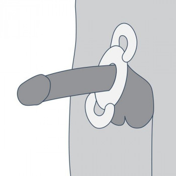 Anneau de constriction de MedIntim