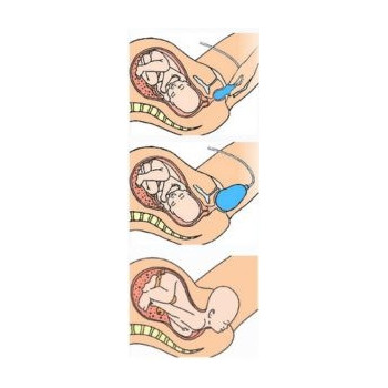 EPI-NO DELPHINE PLUS