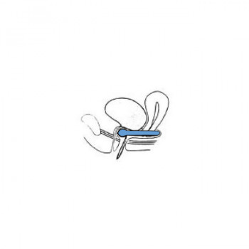 Urethral pessary with button